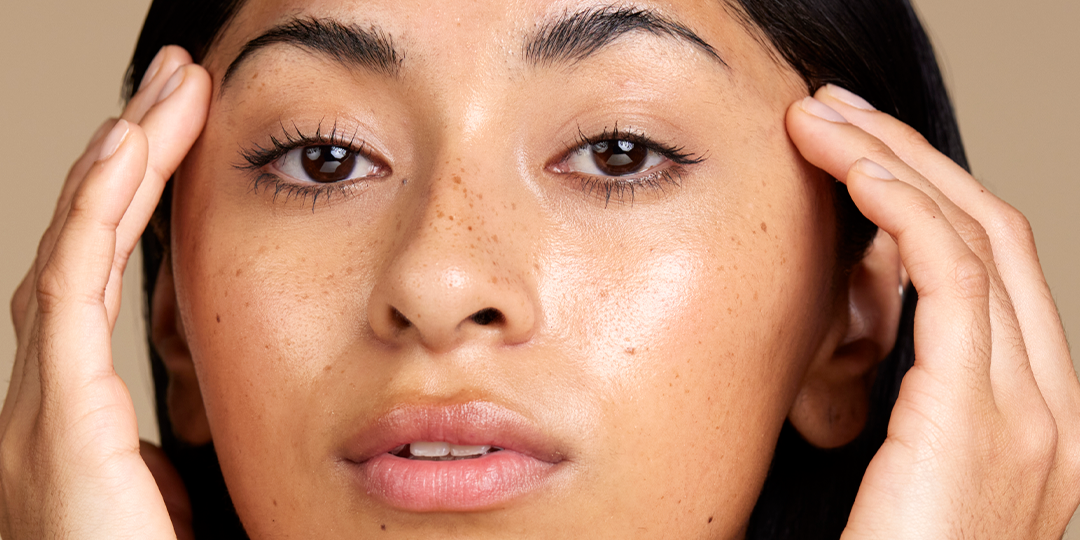 How to Get Rid of Hyperpigmentation Naturally